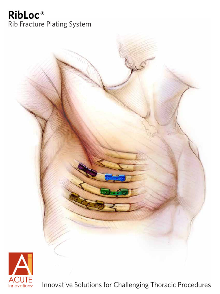 RibLoc® System for Rib Fracture Repair | PDF | Screw | Drill