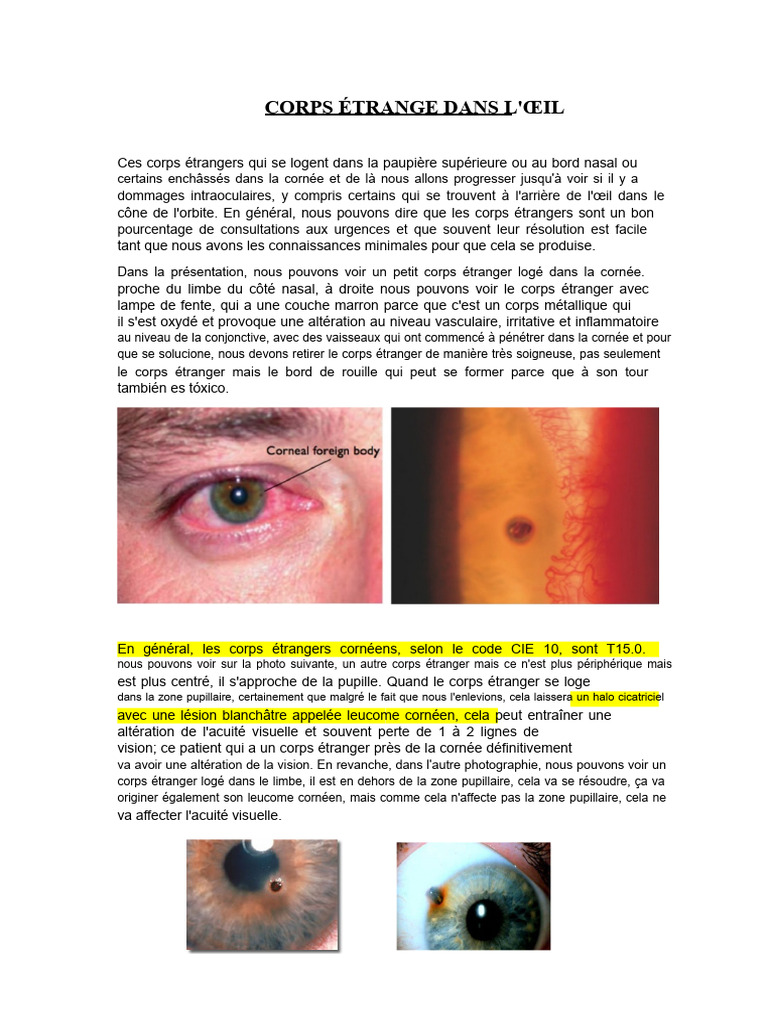 Corps étrangers oculaires symptômes et traitement PDF Cornée — free download
