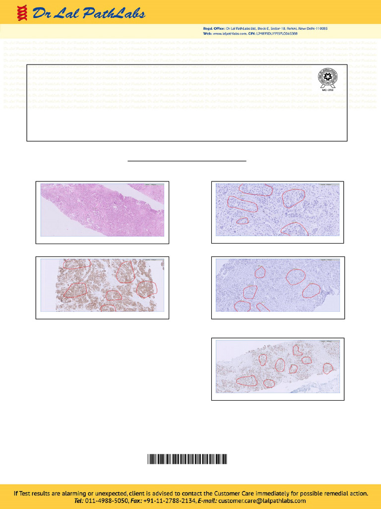 Breast Cancer Immunohistochemistry Report | PDF | Immunohistochemistry ...