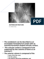 Acetabular Fracture