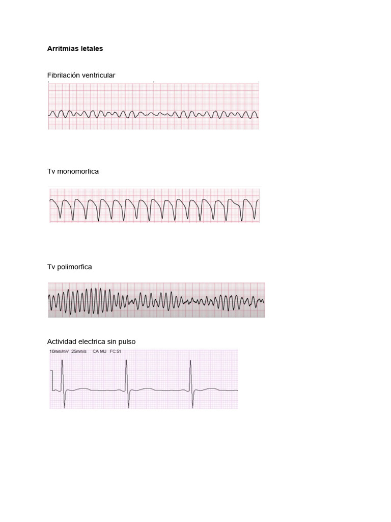 Ritmos Cardiacos | PDF