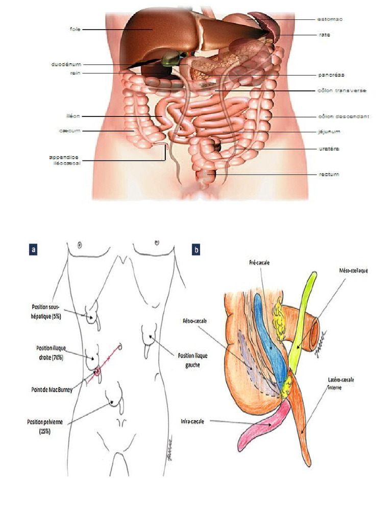 Diagnostic et traitement de l'appendicite aiguë | PDF ...