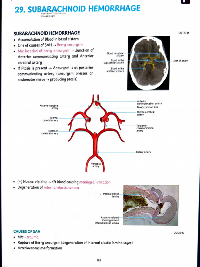 Understanding Subarachnoid Hemorrhage | PDF | Headache | Nervous System