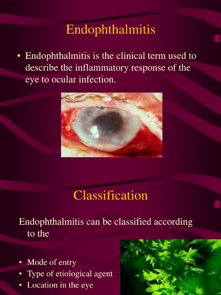 Endophthalmitis in recent advance ophthalmology | PDF