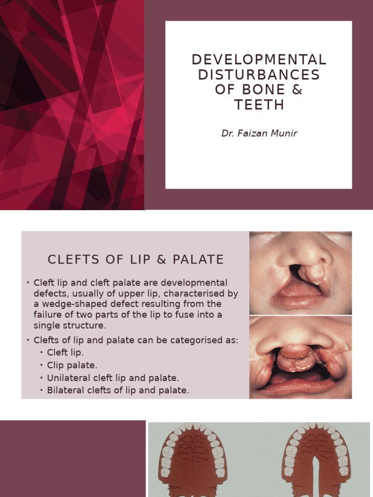 Developmental Disturbances of Bone & Teeth | PDF | Human Head And Neck ...