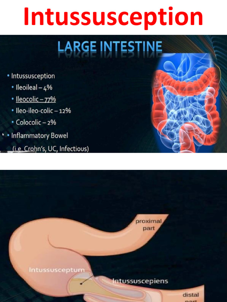 Understanding Intussusception in Adults | PDF