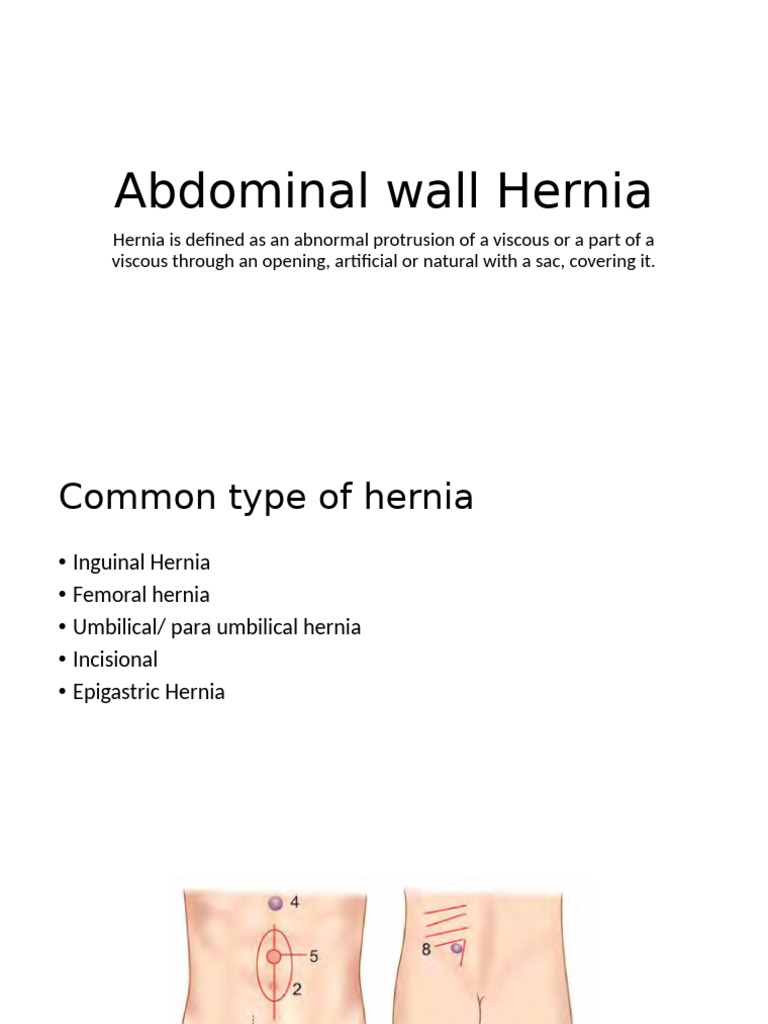 Comprehensive Guide to Abdominal Hernias | PDF
