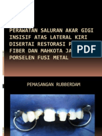 Perawatan Saluran Akar Gigi Insisif Atas Lateral Kiri