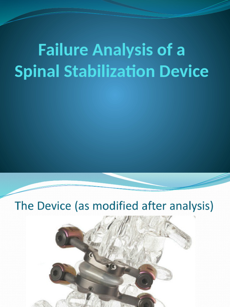 Failure Analysis of a Spinal Stabilization Device | PDF
