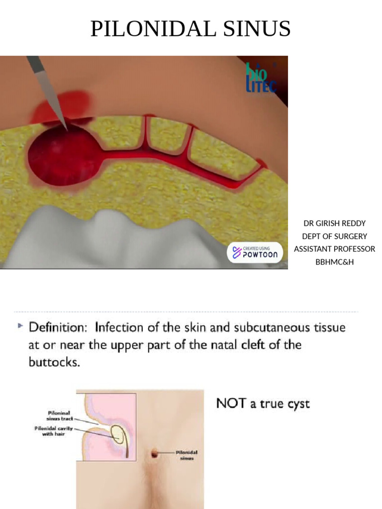 Pilonidal Sinus and Anal Fissure Diagnosis | PDF
