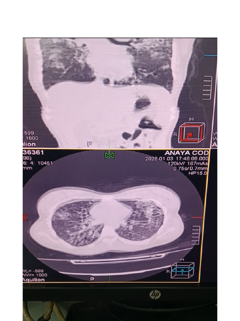 Non-contrast Chest CT Findings Report | PDF