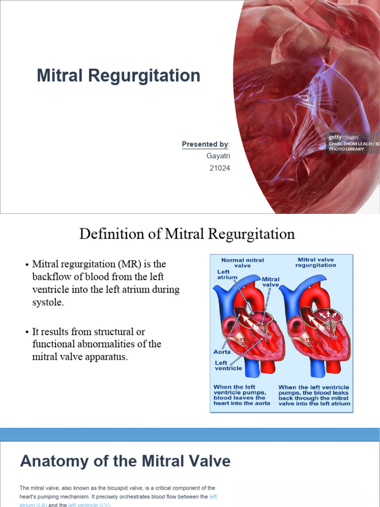 Understanding Mitral Regurgitation | PDF | Heart | Heart Valve