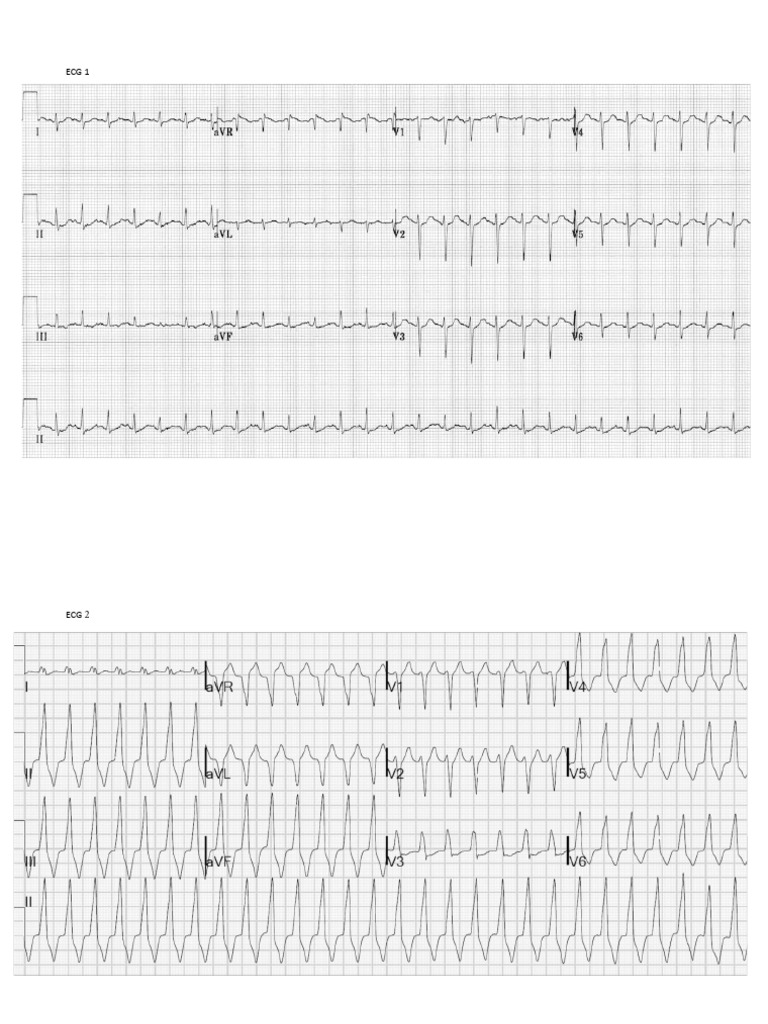 ECG Workshop 3.2 - workbook (update) | PDF