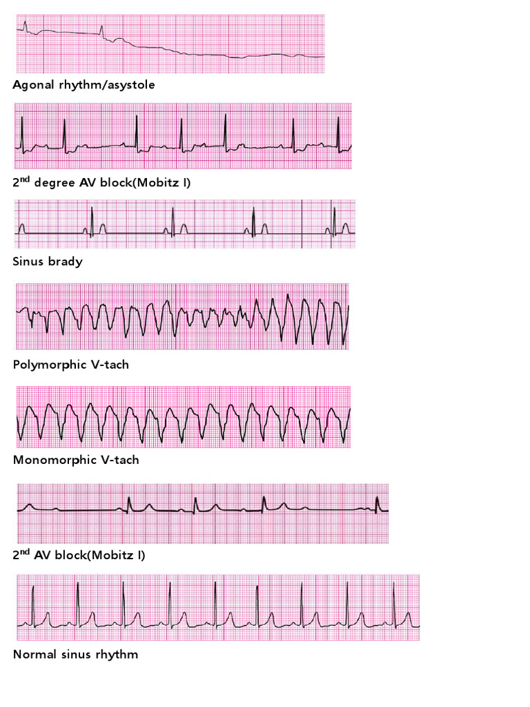 Cardiac Rhythm Abnormalities Overview | PDF