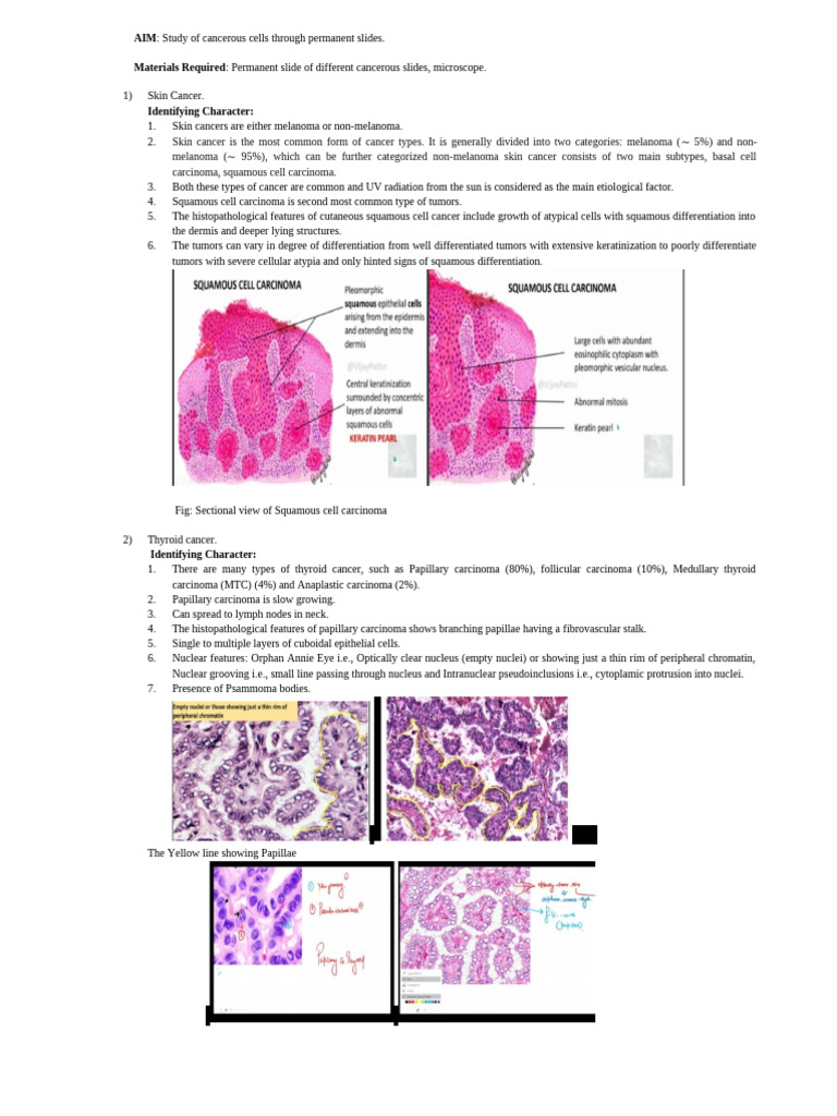 Cancer Cell Identification Guide | PDF | Adenocarcinoma | Skin Cancer