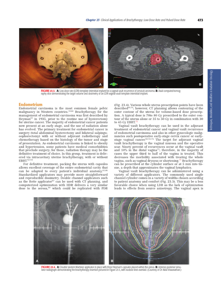 Brachytherapy Techniques for Cancer Treatment | PDF | Radiation Therapy ...