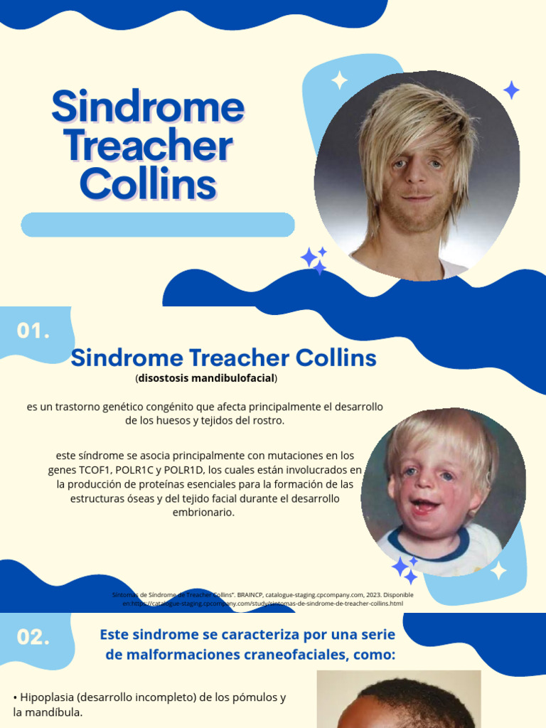 Síndrome de Treacher Collins: Causas y Síntomas | PDF | Genética ...