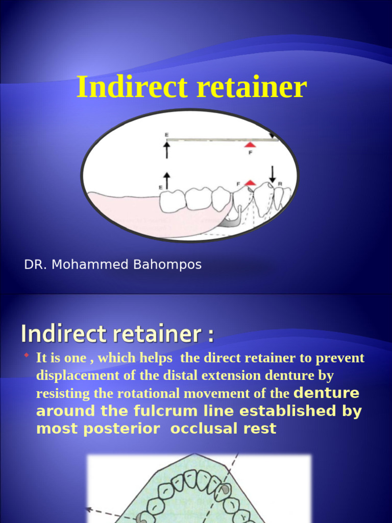Understanding Indirect Retainers in RPDs | PDF | Dentures | Tooth