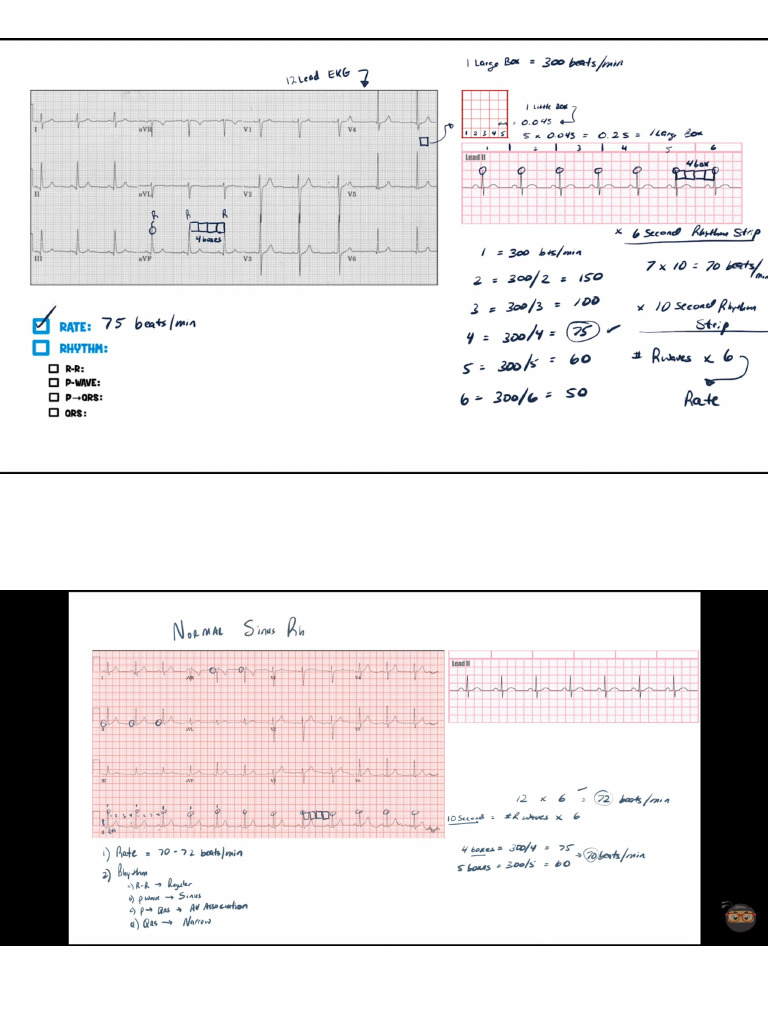 Ecg | PDF