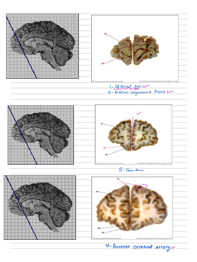 Callosomarginal Artery and Brain Anatomy | PDF | Corpus Callosum ...