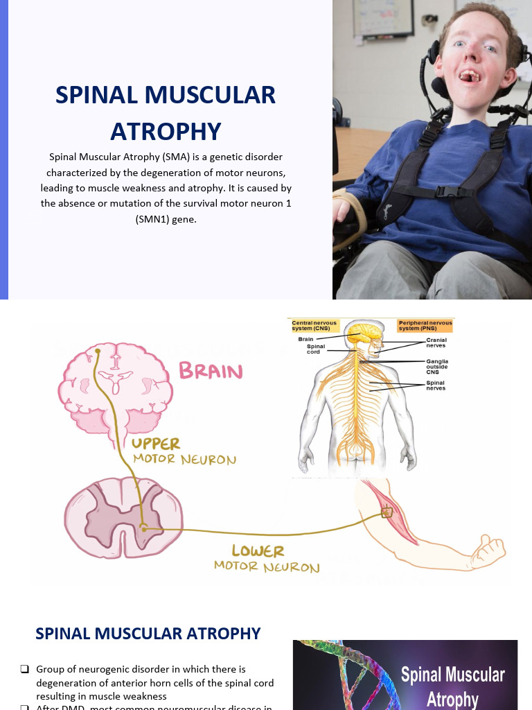 Understanding Spinal Muscular Atrophy | PDF | Nervous System | Medical ...
