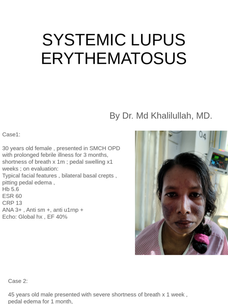 Systemic Lupus Erythematosus Overview | PDF | Clinical Medicine | Human ...