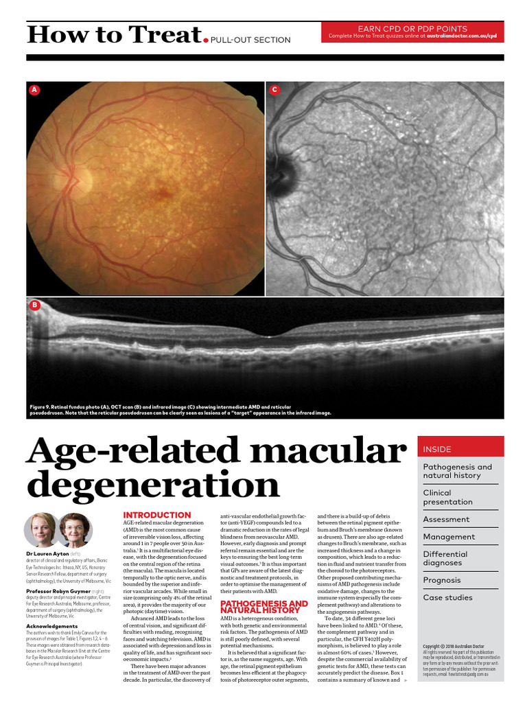Macular Degeneration Age-related | PDF | Ophthalmology | Medical ...
