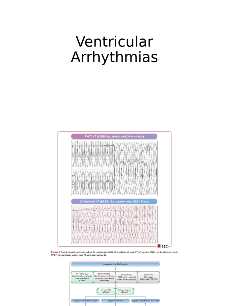 Ventricular Arrhythmias | PDF