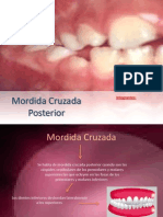 Mordida Cruzada Posterior