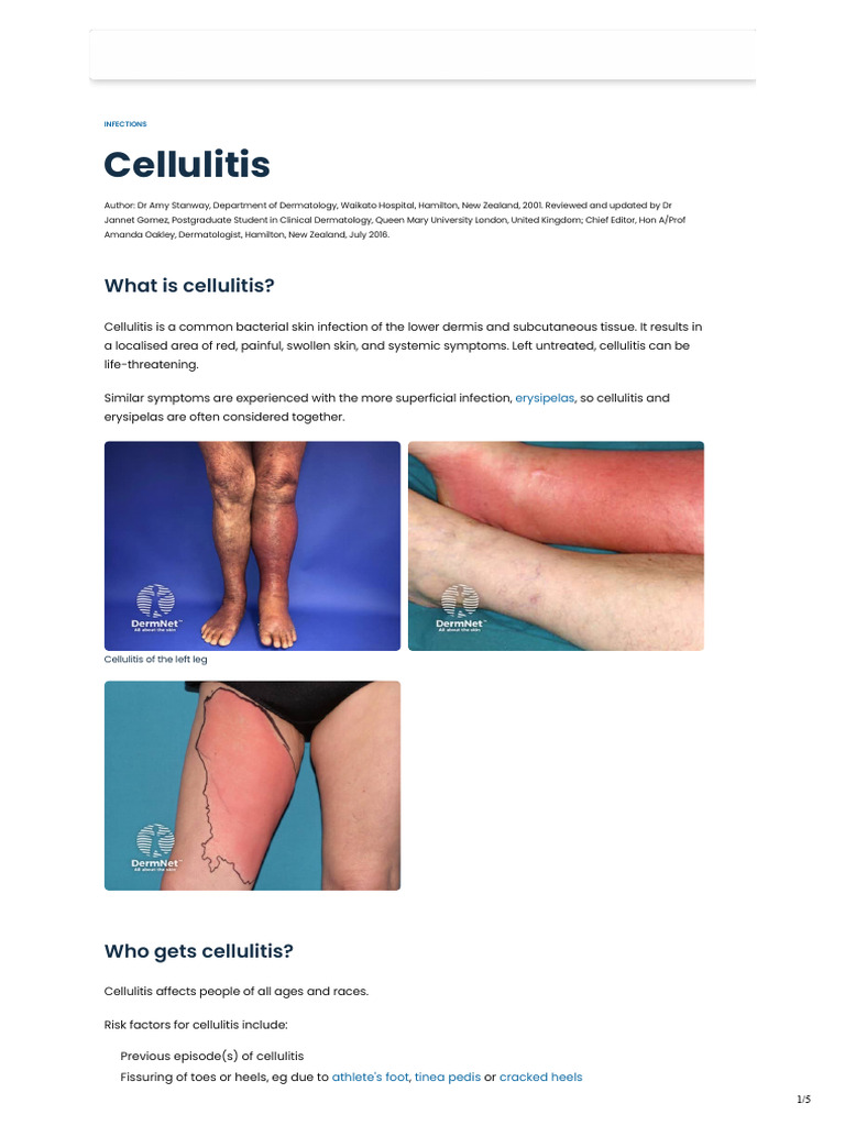 Cellulitis - Symptoms, Causes, Treatment and More - DermNet | PDF ...