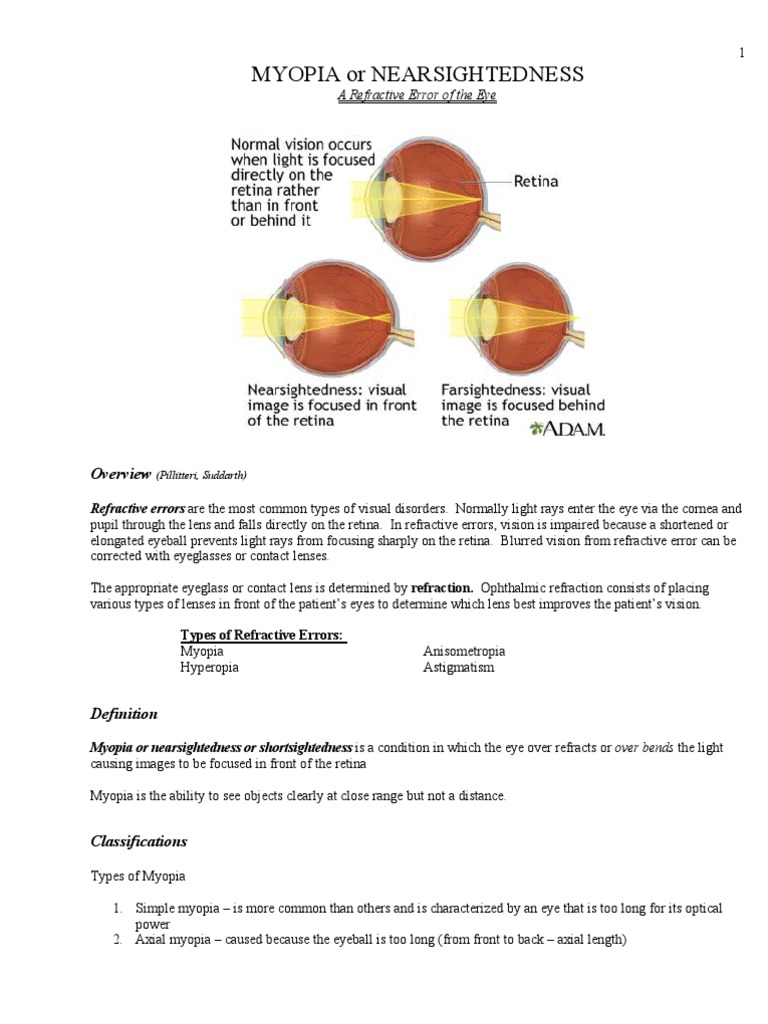 Myopia: Understanding and Management | PDF | Human Eye | Contact Lens