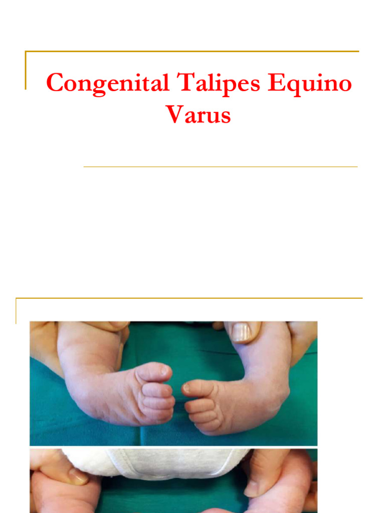 Congenital Talipes Equino Varus | PDF | Medical Specialties | Diseases ...