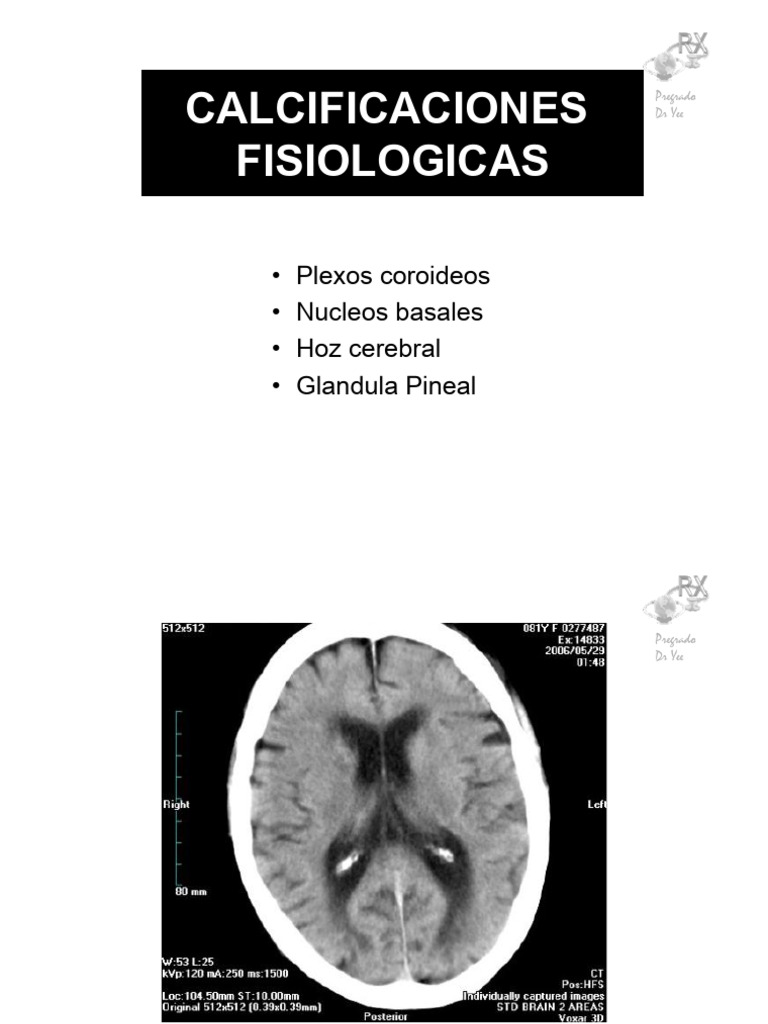 2.4.1 Calcif Cerebral Fisio | PDF