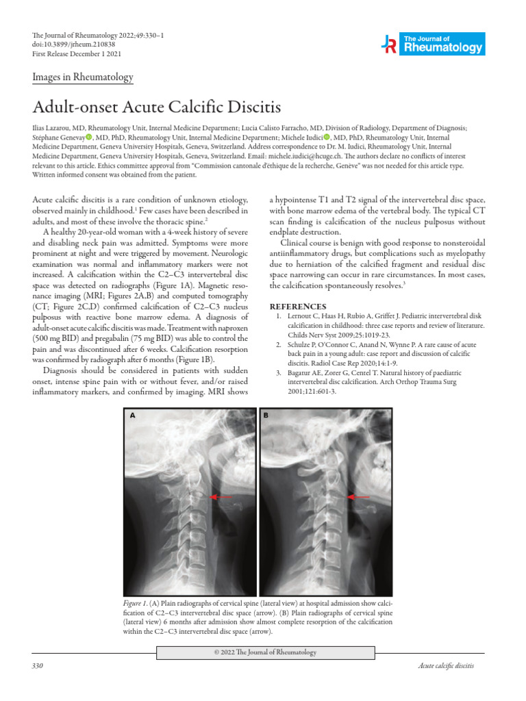 Adult Onset Acute Calcific Discitis 2022 | PDF | Medicine | Diseases ...
