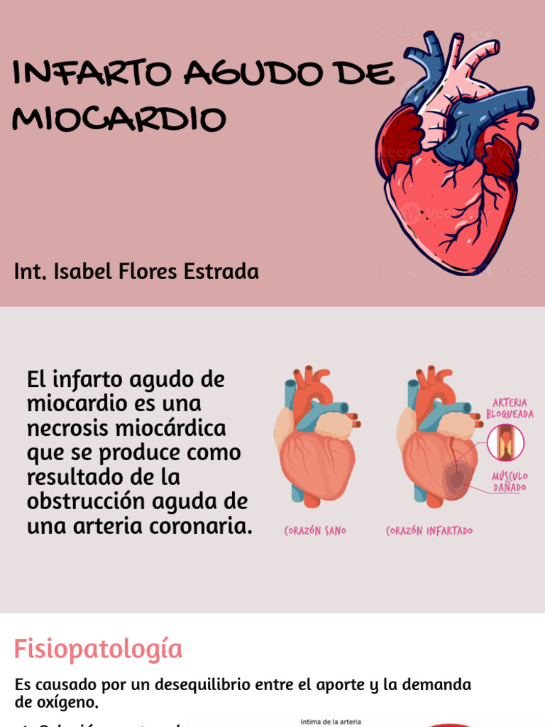 Infarto Agudo de Miocardio | PDF | Infarto de miocardio | Sistema ...