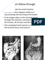 Barium Follow-Through TBL