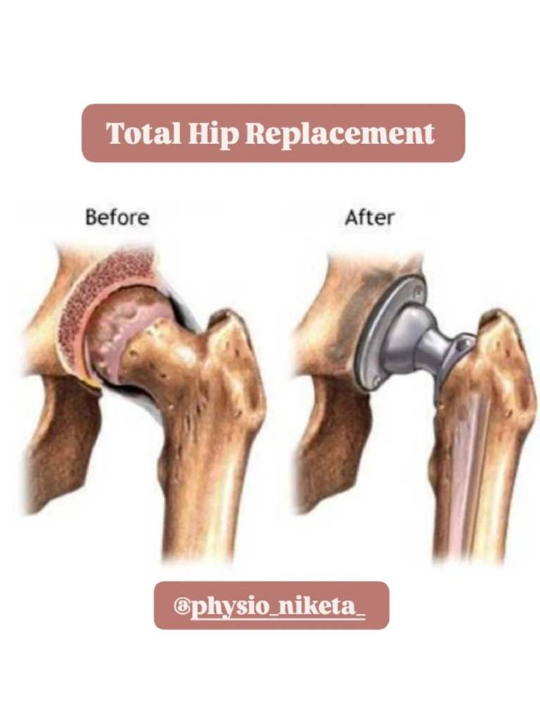 Total Hip Replacement 2026-02-05 20-35-12 | PDF
