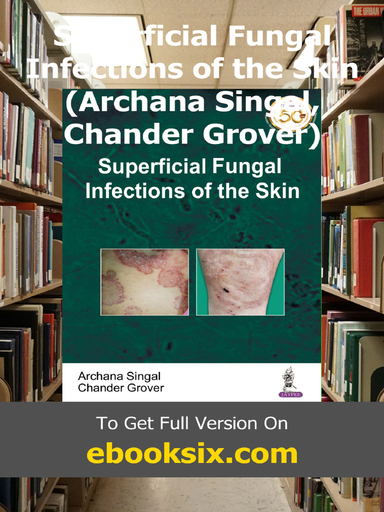 Superficial Fungal Infections of The Skin Archana Singal Chander Grover ...