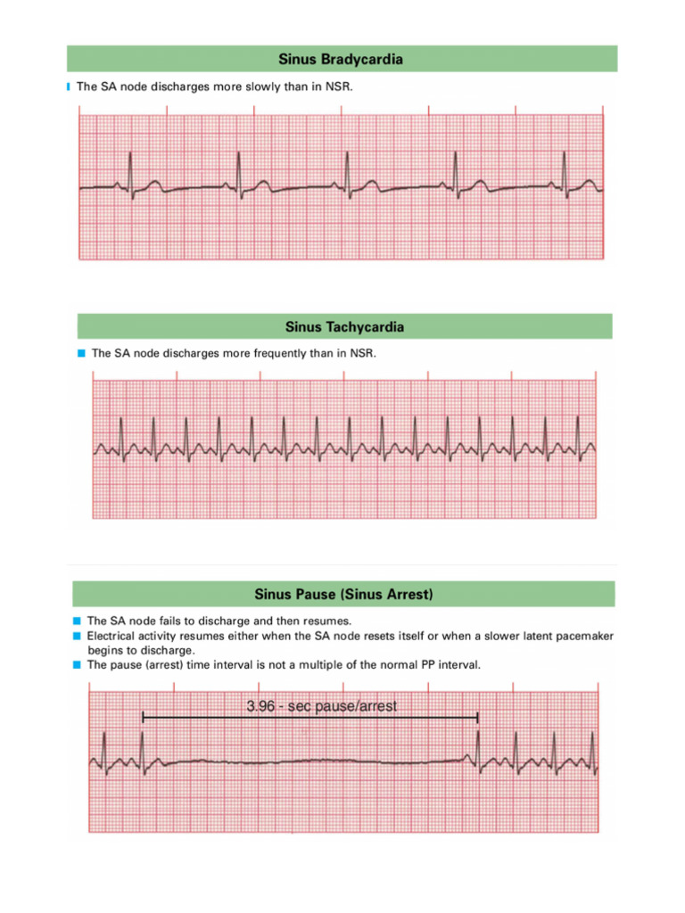 Ecg Lead Pattern | PDF