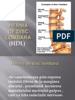 Hernia de Disc Lombara