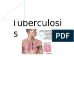 CHN Tuberculosis