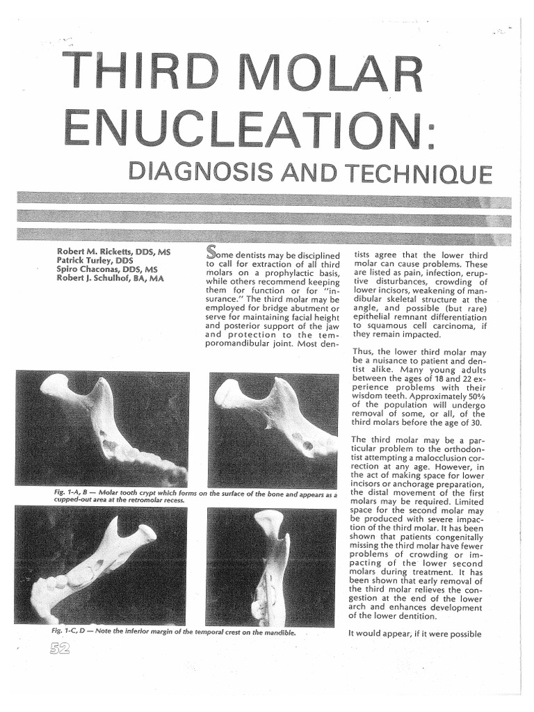 Third Molar Enucleation | PDF