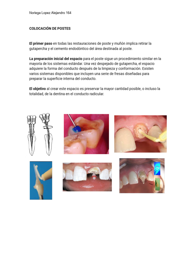 Endoposte PDF | PDF