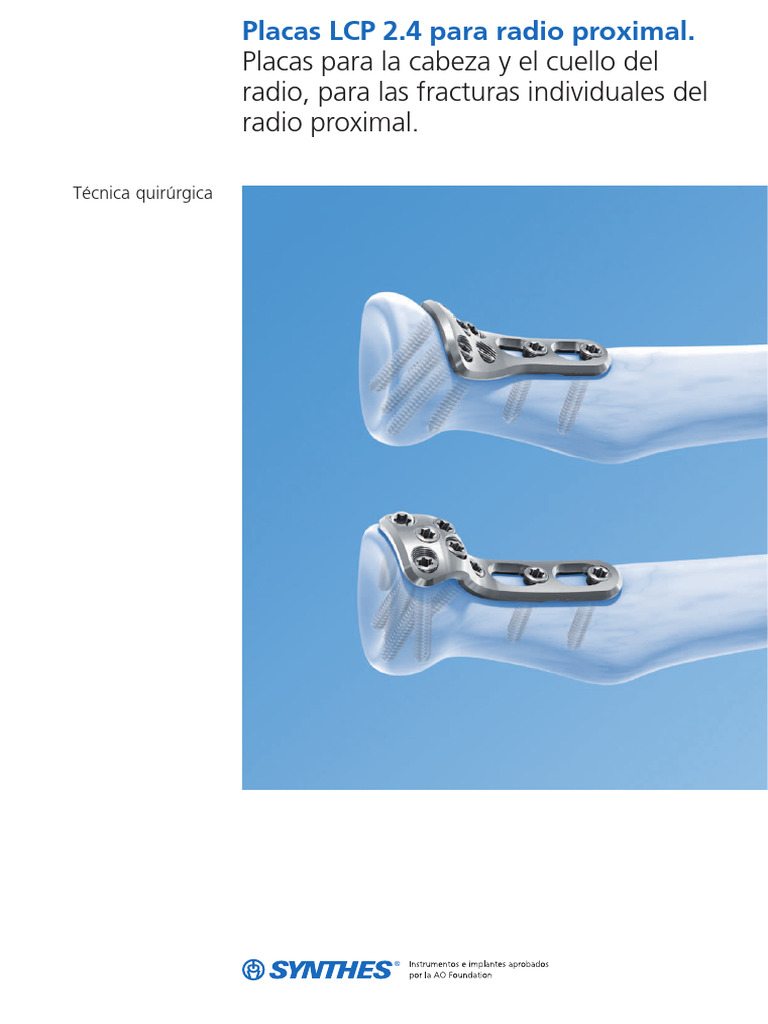 Placas LCP 2.4 para Radio Proximal | PDF | Tornillo | Codo