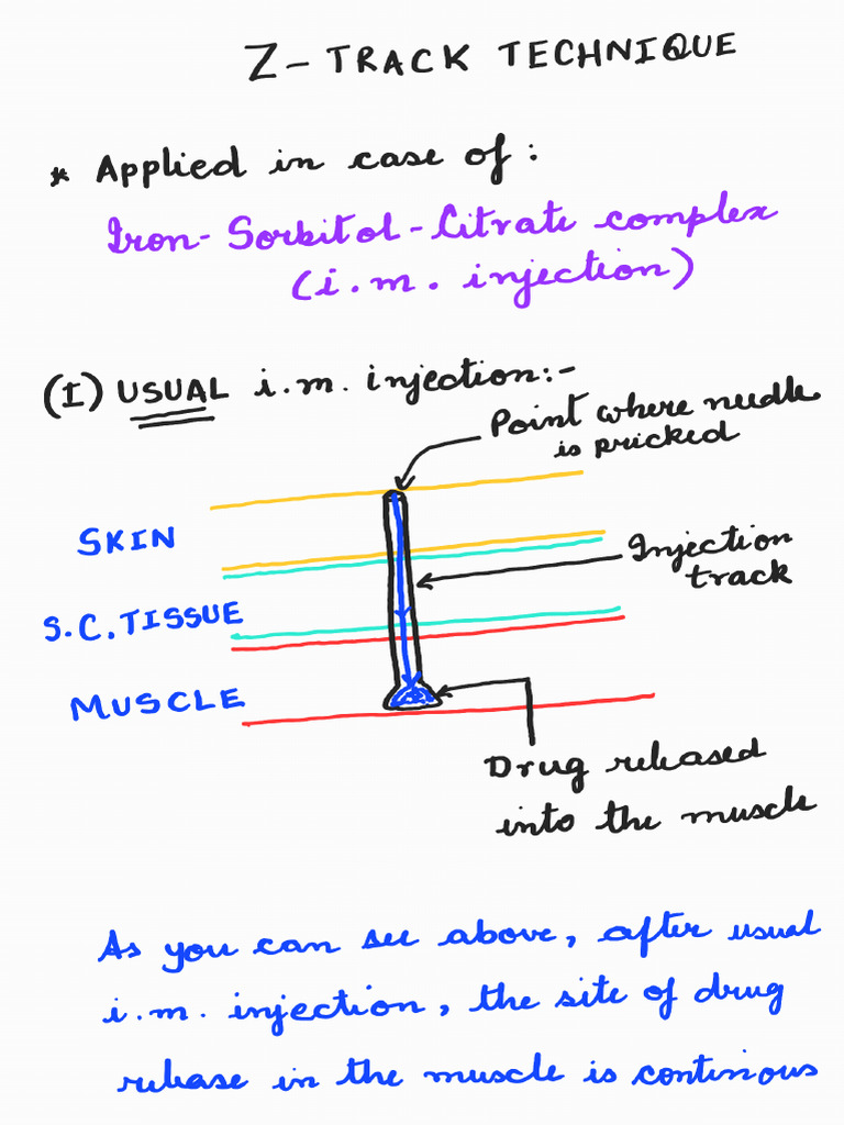 02 Z-Track Technique | PDF