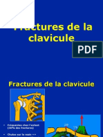 02-Clavicule+Fract-Luxat
