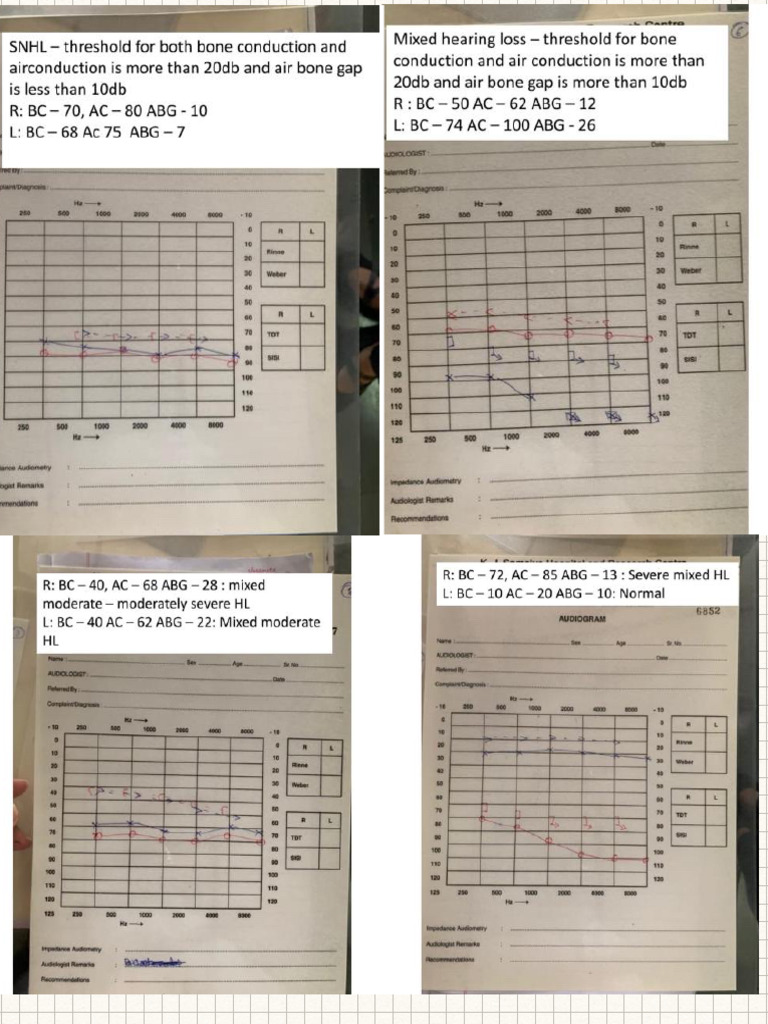 Pure Tone Audiometry | PDF