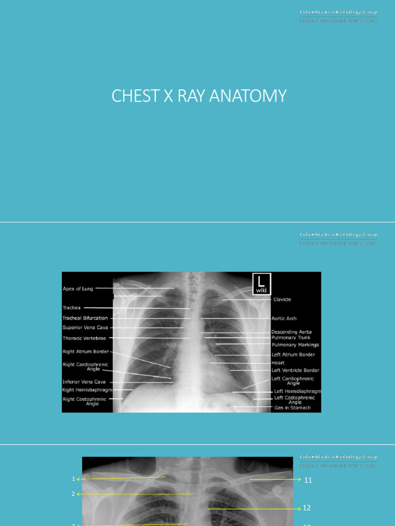Study Material Anatomy Chest Xray | PDF | Aorta | Thorax