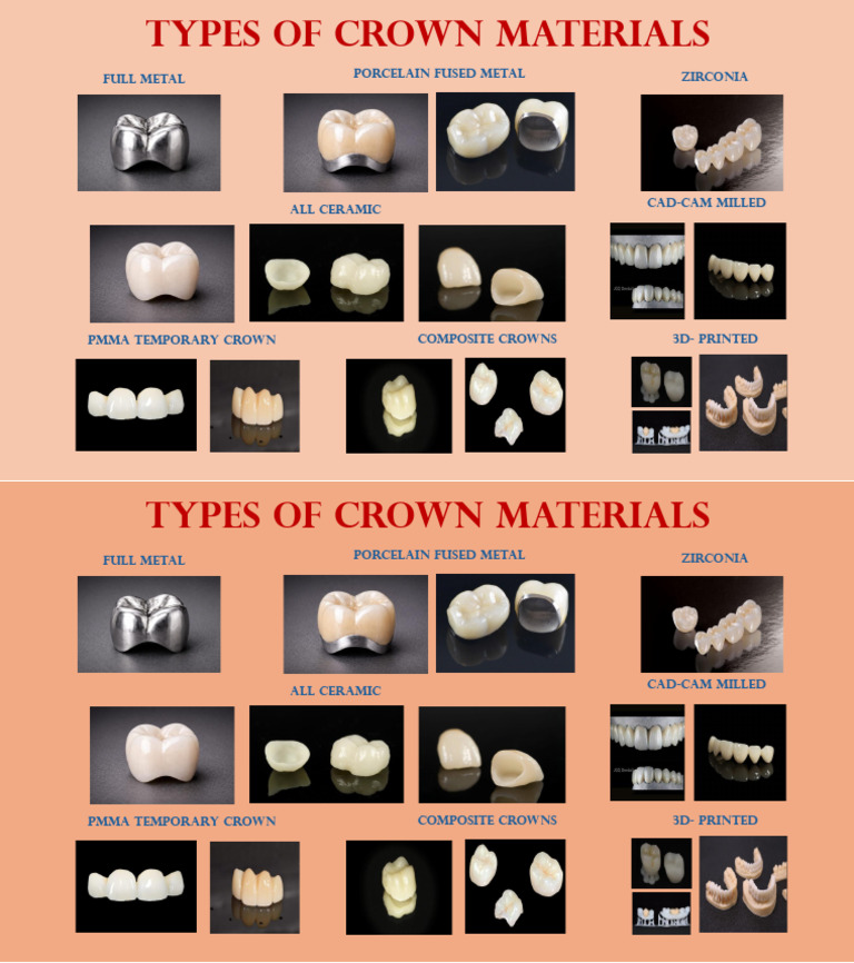 Types of Crown Materials | PDF