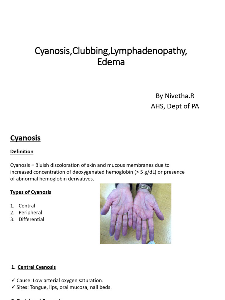 Nivetha ppt2 | PDF | Edema | Medicine
